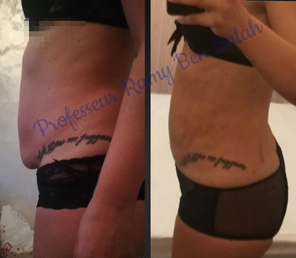 bodytite-avant-apres