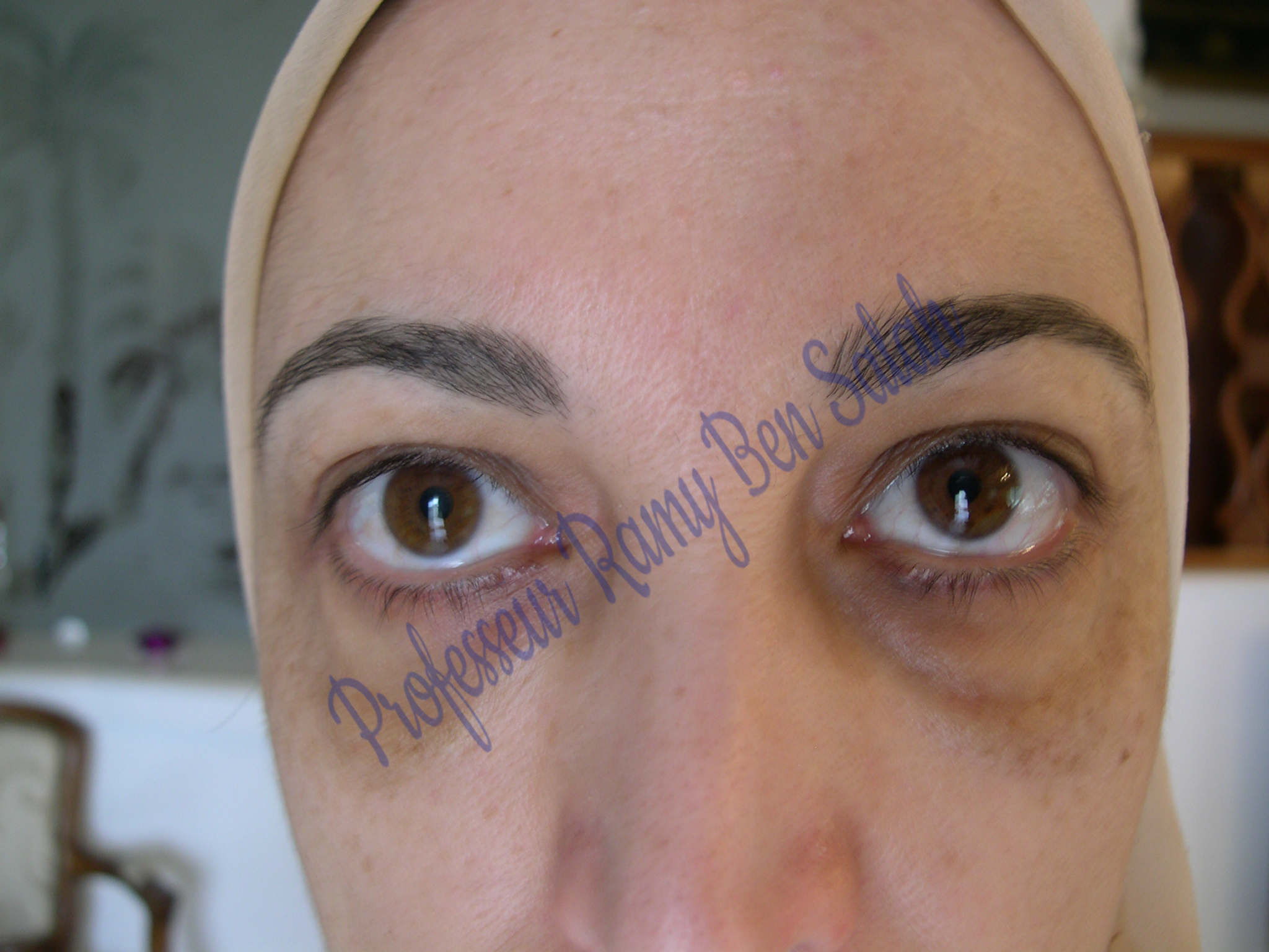 chirurgie-paupieres-apres