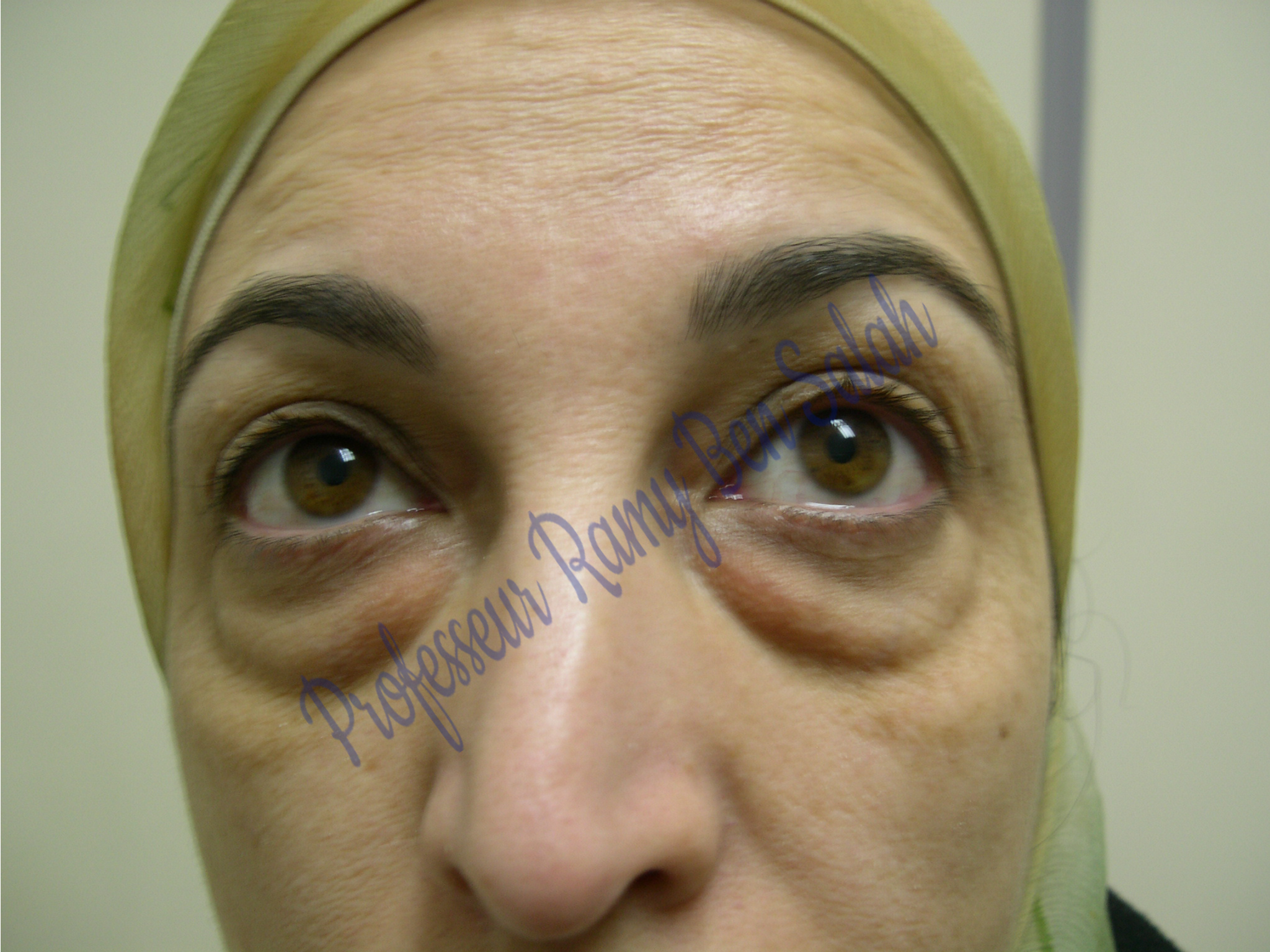 chirurgie-paupieres-avant