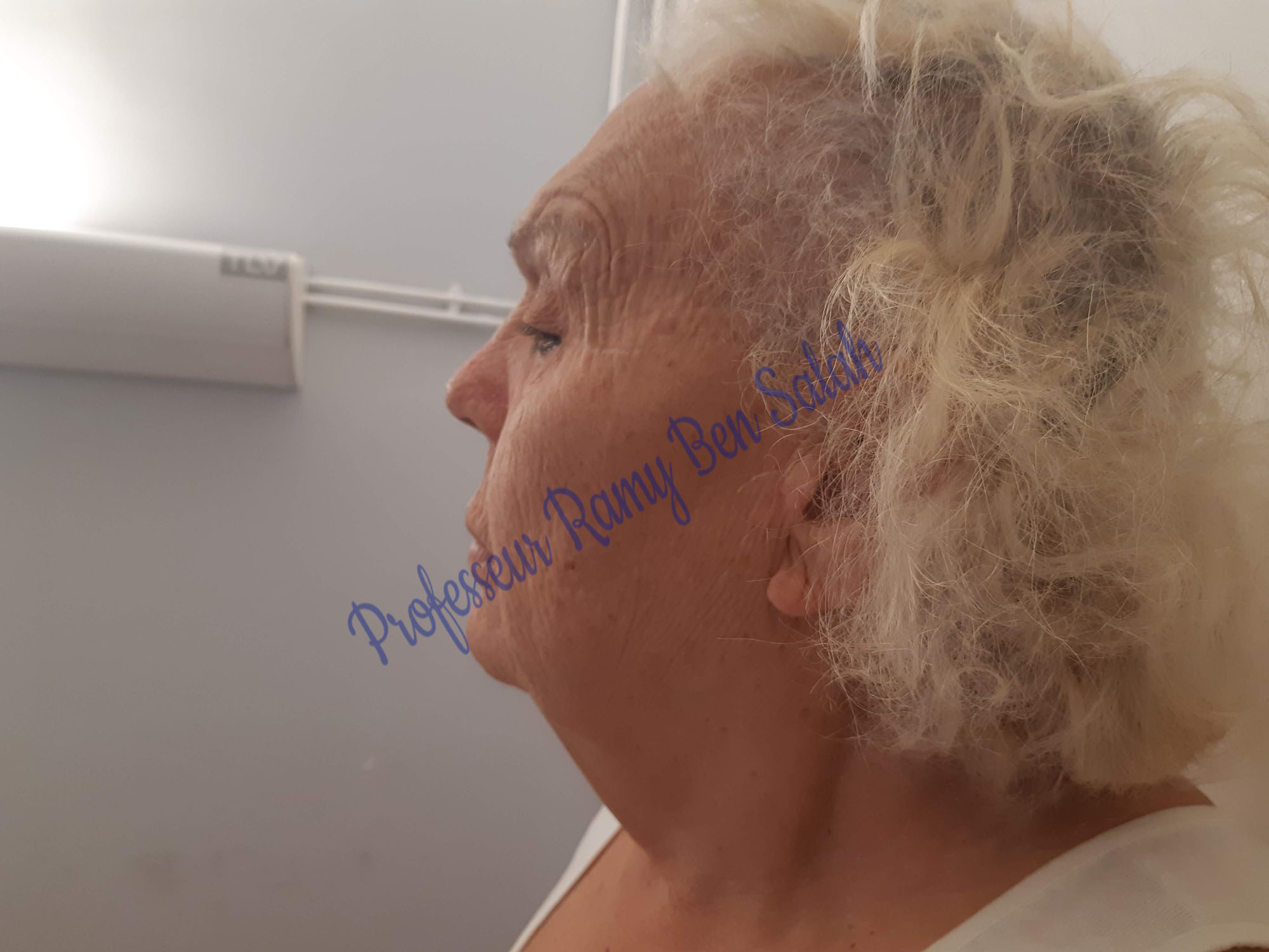 lifting-avant-profil