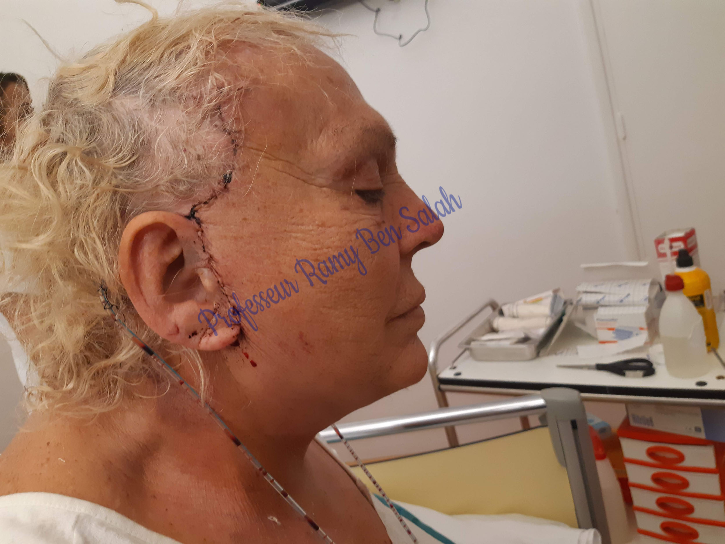 lifting-profil-apres