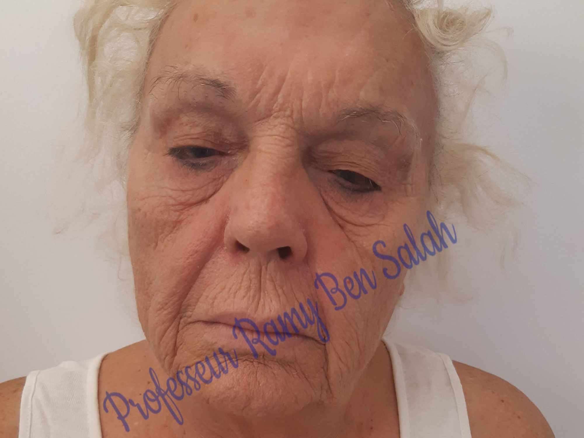 lifting-visage-avant