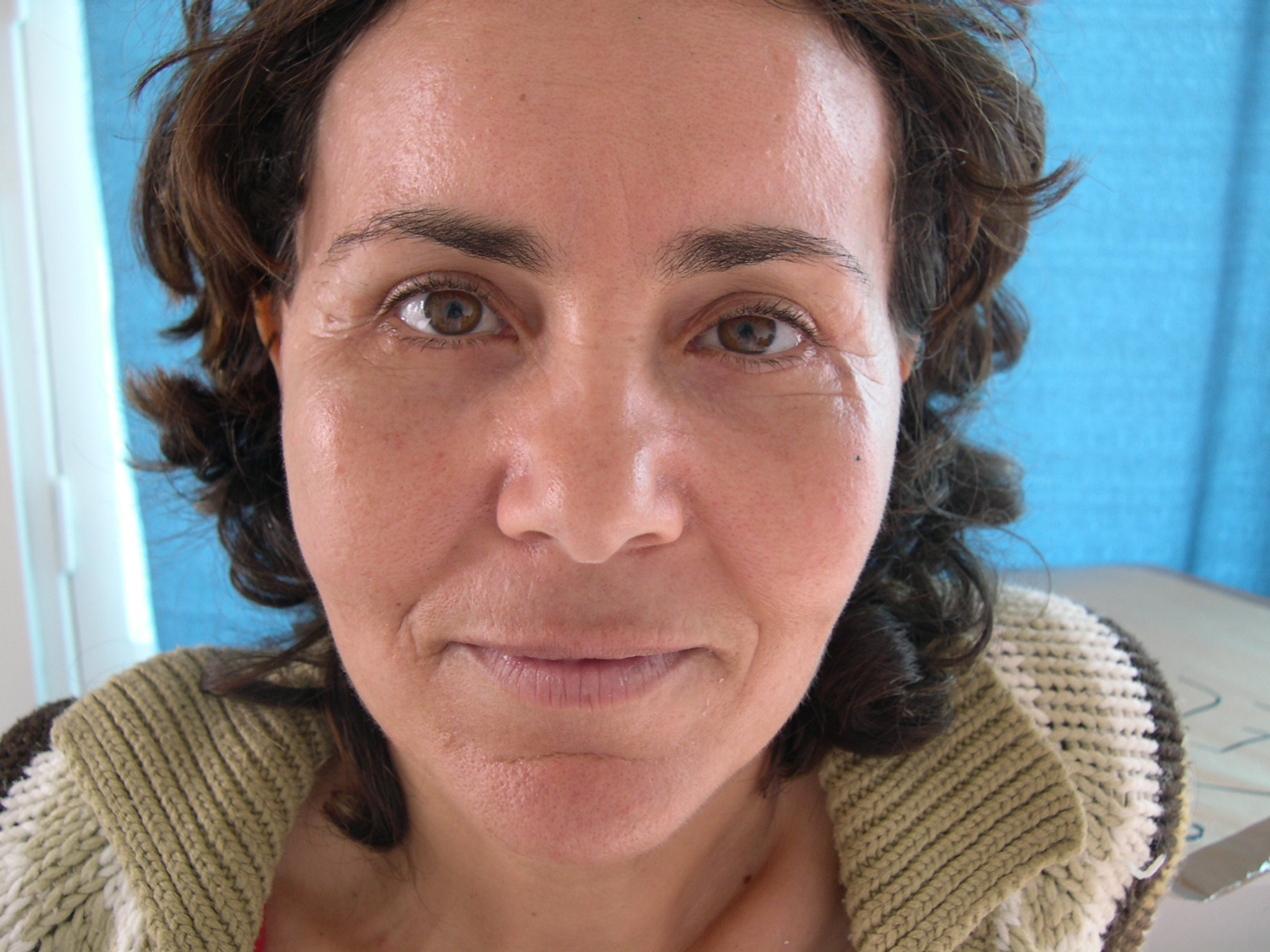 protheses-malaires-apres