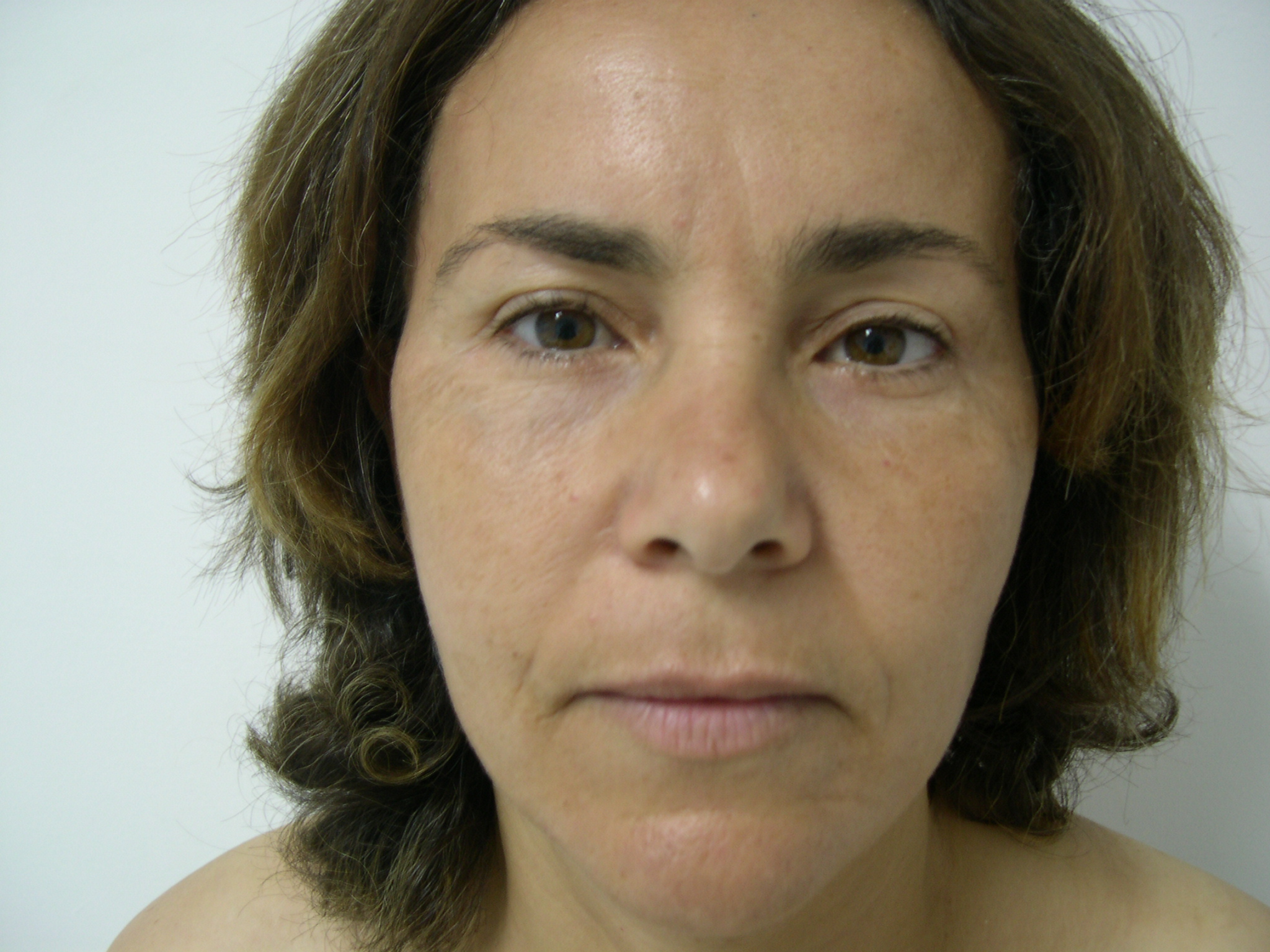 protheses-malaires-avant