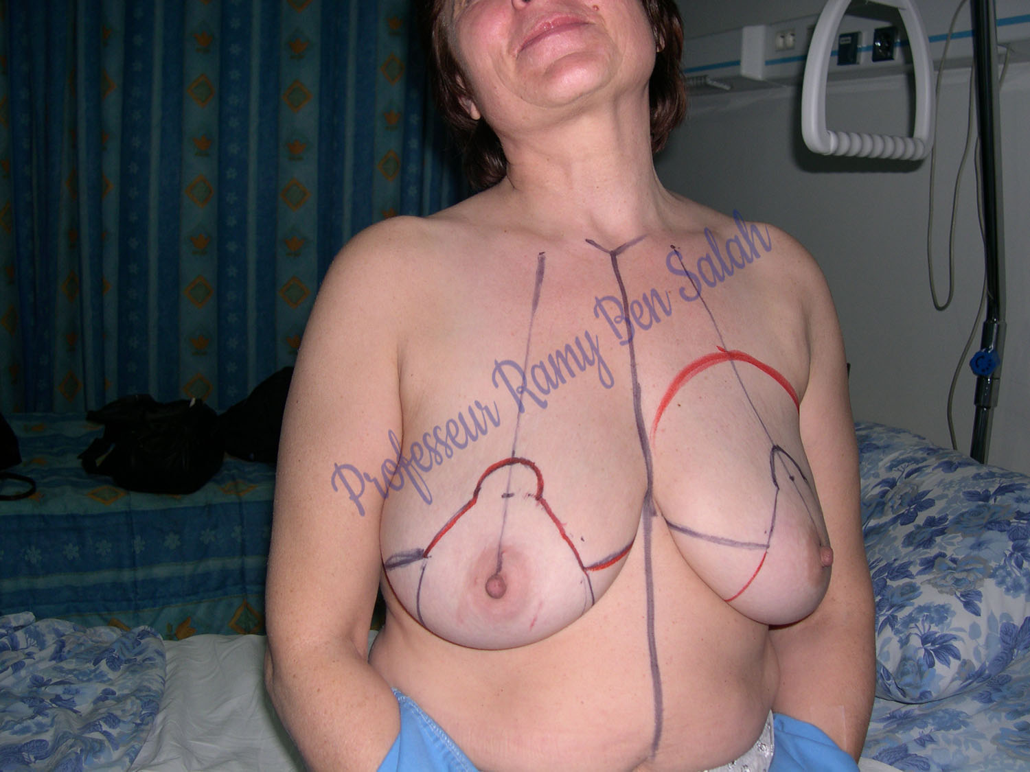 reconstruction-mammaire-avant