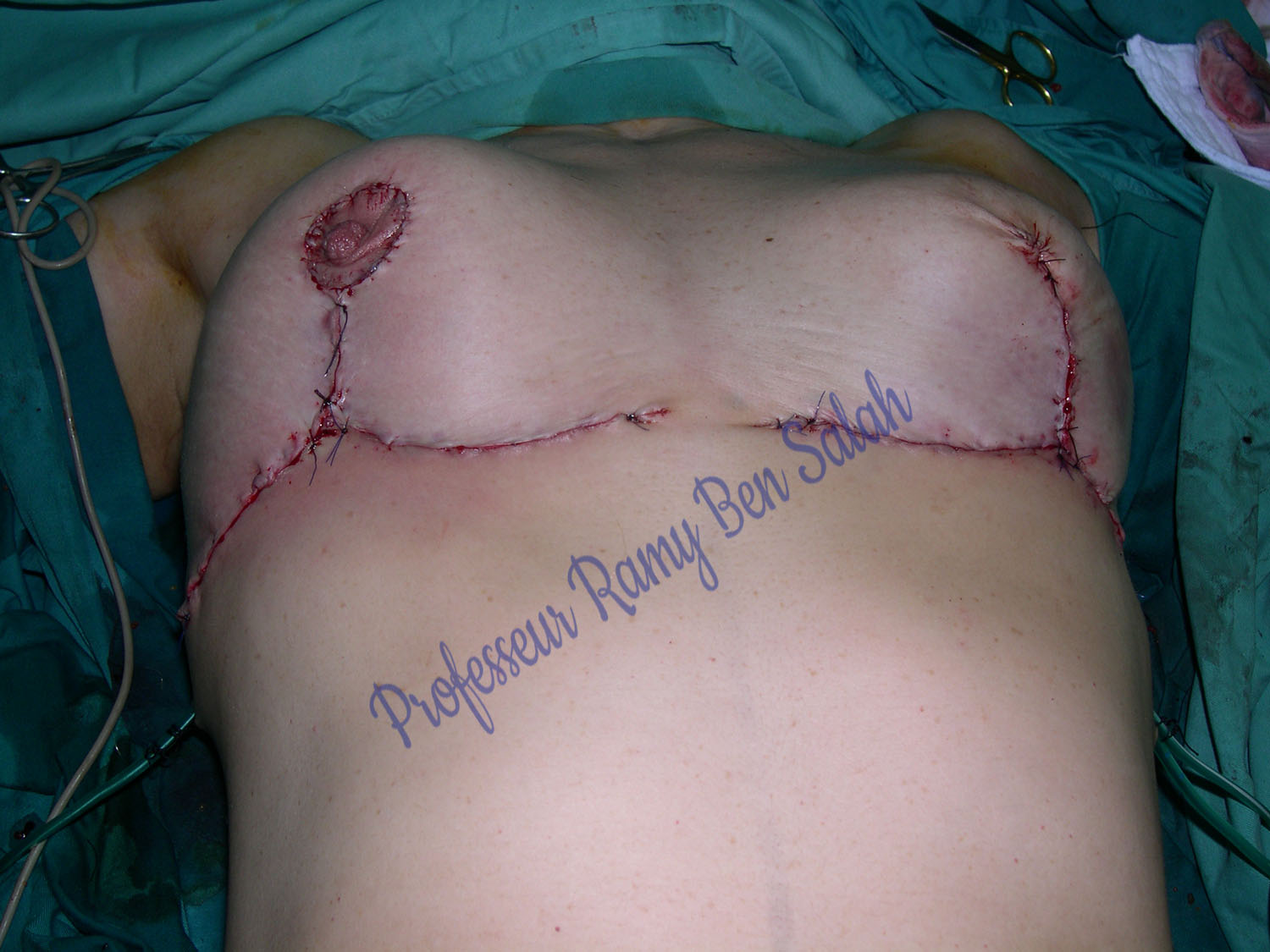 reconstruction-mammaire-operation