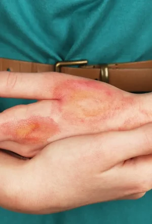 img_2__derme-artificiel