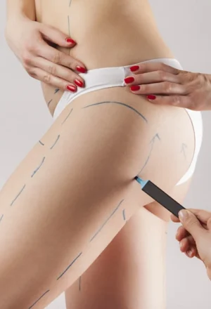 img_2__lifting-des-cuisses