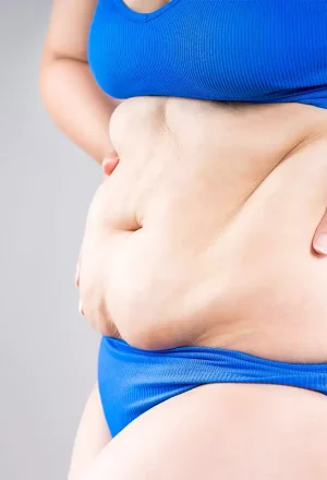 img_2_chirurgie-post-bariatrique