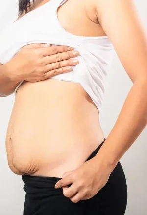 img_2_chirurgie-post-partum